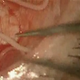 Illustration for article titled Watch a five-inch worm being pulled from a mans eyeball
